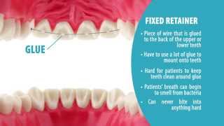 Retainers  Orthodontic Video Production [upl. by Aven]