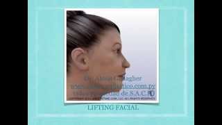 Estiramiento de cara y cuello  lifting facial [upl. by Neille989]