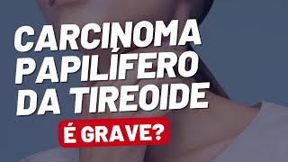 Carcinoma Papilífero de Tireoide o Câncer Mais Comum da Tireoide [upl. by Domineca187]