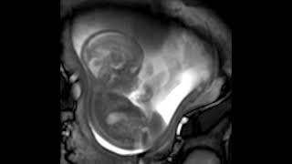 MRI scan at 21 weeks [upl. by Misty]