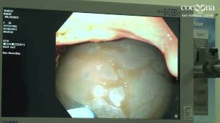 Gastric Balloon Removal Proceudre [upl. by Koenraad553]