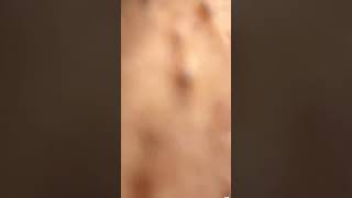 MEUS CABELOS ENCRAVADOS INGROWN HAIR 🤢 [upl. by Niac181]