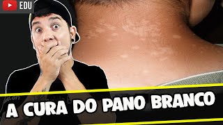 MANCHAS BRANCAS NA PELE PANO BRANCO  CAUSAS SINTOMAS E TRATAMENTO │BioSaúde [upl. by Coward282]