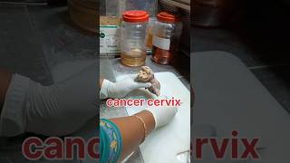 Cancer cervix specimen grossing pathology cancer cervicaltreatment cervicalcancersymptoms [upl. by Mensch]