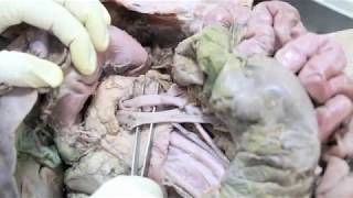 Anatomy Dissection of Pancreas amp Duodenum [upl. by Iva]