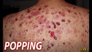 Severe Back Acne What is Bacne [upl. by Fita]