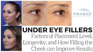 Possible Causes of Lumpiness with Under Eye Fillers and How Adding Cheek Volume Can Help [upl. by Yeltrab273]