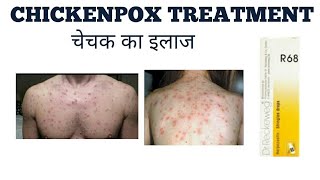 chickenpox treatment चेचक का इलाज [upl. by Polivy]