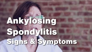 Ankylosing Spondylitis  Signs and Symptoms 2 of 5 [upl. by Naasah]