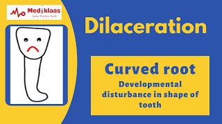 Dilaceration l Developmental tooth alteration l Oral pathology l Mediklaas [upl. by Aihsekal]