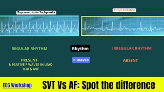 ECG Workshop SVT amp AF on simulation [upl. by Anehta]