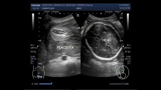 Ultrasound Video showing Oligohydromnios  almost Anhydramnios  with Pregnancy of 30 weeks [upl. by Eves]