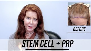 Female STEM CELL  PRP Hair Restoration Success Story [upl. by Nolur]