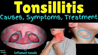 Tonsillitis – Causes Symptoms Diagnosis Treatment Complications amp Prevention [upl. by Illene]