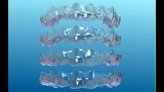 Orthodontic Clear aligners how aligners work invisalign [upl. by Balduin]