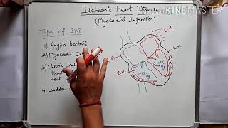 Ischaemic heart disease  Myocardial infarction in hindi Part1 [upl. by Spiros]