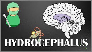 Hydrocephalus  Causes Types Signs and Symptoms Pathophysiology Diagnosis and Treatment [upl. by Maya]