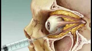 Eye Anesthesia Retrobulbar block [upl. by Christabella]