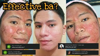 Derma Pen 3rd Session  Question and Answer About Microneedling  DYNEL BEO [upl. by Dace]