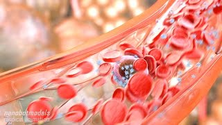 Metastasis and angiogenesis [upl. by Unders250]