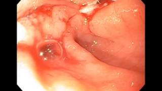 Gastric Outlet Obestruction from Pyloric Ulcers [upl. by Ssej750]