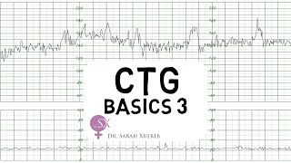 CTG Basics Part 3  Overall Assessment amp Examples [upl. by Roid742]