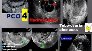 lecture 5 ultrasound of ovary amp adnexa part 2 [upl. by Lanni]