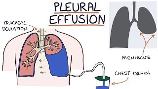 Understanding Pleural Effusions [upl. by Nelloc254]