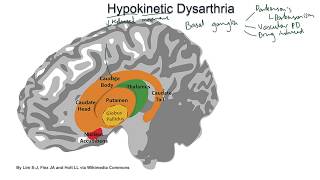 Hypokinetic Dysarthria  examples and tutorial [upl. by Yrellav468]