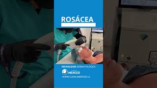 Tratamiento Láser Para Eliminar la Rosácea 😳👩‍⚕️👨‍⚕️ [upl. by Elocn]