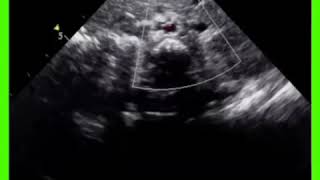 Dextrocardia Situs Inversus Echocardiography [upl. by Ardnosac]