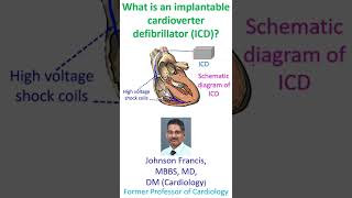 What is an implantable cardioverter defibrillator ICD [upl. by Sredna]