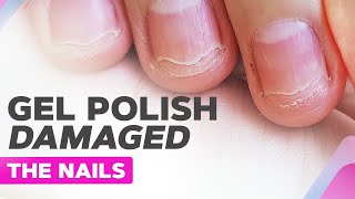 Badly Damaged Nails  Gel Polish Allergy Nail Plate Burn Onycholysis [upl. by Anahs]