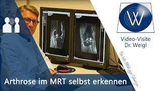 Knieschmerzen Knieverletzung amp Kniearthrose im MRT  Diagnose Arthrose Kreuzbandriss Meniskus [upl. by Isaac]