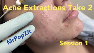 Acne extractions take 2 session 1 Blackheads whiteheads Ears 20 minutes of just the pop ASMR [upl. by Aicylla]