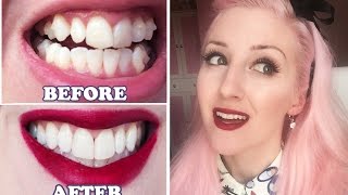 Invisalign BEFORE amp AFTER My Experience [upl. by Eahcim]