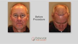 NeoGraft Hair Transplant Testimonial  Denver Hair Surgery [upl. by Noslen540]