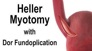 Heller Myotomy with Dor Fundoplication Animation for the Treatment of Achalasia [upl. by Main]