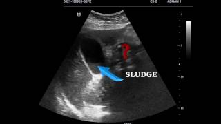 EMERGENCY ULTRASOUND IN RIGHT UPPER QUADRANT PAIN CASE 1 [upl. by Bouldon413]