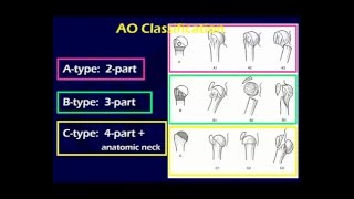 Proximal Humerus Fractures 1 OTA lecture series III u03a [upl. by Rizas]