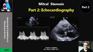 Atrial fibrillation Afib AF  causes symptoms treatment amp pathology [upl. by Ynobe]