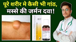 R17 Homeopathic Medicine uses in Hindi  Ganth ki Homeopathic Dawa  Tumor [upl. by Rombert]