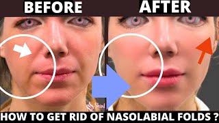 🛑 HOW TO LIFT SMILE LINES  GET RID OF LAUGH LINES WITH FACE YOGA  JOWLS SAGGY SKIN JAWLINE [upl. by Erdreid]