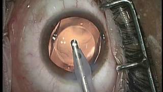 TORIC ICL Implantation [upl. by Llesram144]