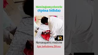 Homoeopathic medicine for meningomyelocele spina bifida homoeopathicmedicine spinabifida drsb [upl. by Veator]