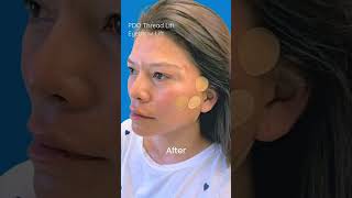 PDO Thread Lift  Eyebrow Lift PCH MedSpa Newport Beach [upl. by Fantasia]