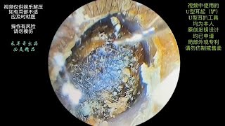 采耳哥Hard earwax embolism cleaning of ear canal and tympanic membrane dry film [upl. by Zahara]