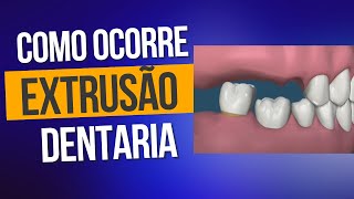 Como ocorre a extrusão dentaria dralexguedes [upl. by Nabroc]