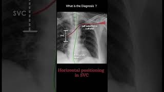 Horizontal positioning in SVC 195 chest Xray tubes Quiz radiologychannel007 [upl. by Myrta]