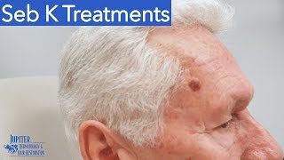 Seborrheic Keratosis Treatment amp Removal Liquid Nitrogen amp Curetagge [upl. by Nyladnar]